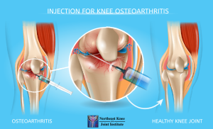 hyaluronic acid injections knee cost