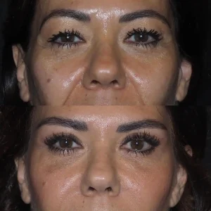 Eye Bag removal in Dubai